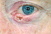 Squamous cell cancer on the eyelid