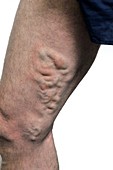 Varicose veins on the thigh