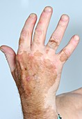 Vitiligo on the hand
