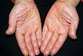 Hands with pityriasis rubra pilaris
