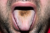 Black hairy tongue from antibiotic drug