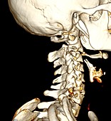 Broken neck,3D CT scan