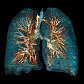 Emphysema,3D CT scan