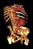 Abdominal aortic aneurysm,3D CT scan