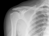 Normal shoulder,X-ray