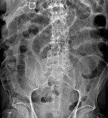 Small bowel obstruction,X-ray