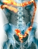 Ulcerative colitis,X-ray