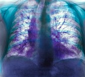 Fibrosing alveolitis,X-ray