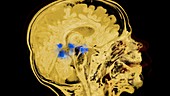 Child's brain activity,MRI scan