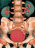 Kidneys and bladder,3D CT scan