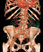 Calcified aortic artery,3D CT scan