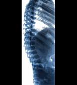 Spine in Hurler Syndrome,X-ray