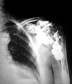 Melorheostosis of the shoulder,X-ray