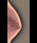 Breast X-ray