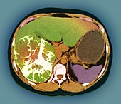 Liver cancer,CT scan