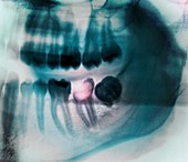 Tooth decay,X-ray