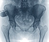 Incontinence implant,X-ray