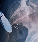 Incontinence implant,X-ray