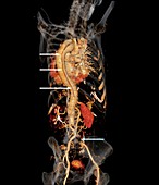 Aortic aneurysm CT scan