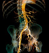 Arteritis,3d CT scan