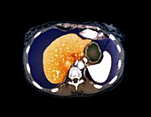 Chronic liver disease,CT scan