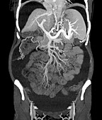 Chronic liver disease,CT scan