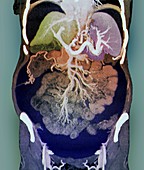 Chronic liver disease,CT scan