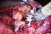 Robotic kidney removal surgery