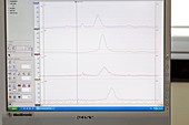 Oesophageal manometry and pH testing