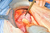 Secondary liver cancer surgery