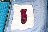 Excised gallbladder