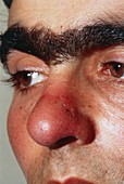 Lupus skin rash