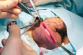 Epididymal cyst removal surgery