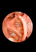 Tensed vocal cords,laryngoscope view