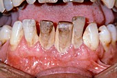 Dental plaque and tartar