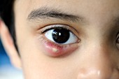 Chalazion in the lower eyelid