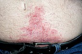 Contact dermatitis from a belt buckle