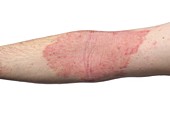Eczema on the arms