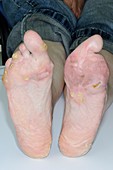 Feet deformities from meningitis