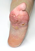 Foot deformity from meningitis
