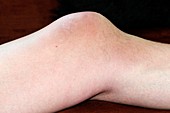 Swollen joint of the knee