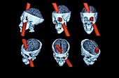 Phineas Gage brain reconstruction