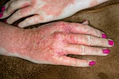 Allergic skin reaction to hand cream