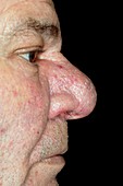 Rhynophyma of the nose