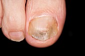 Treated onychomycosis nail infection