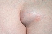 Lipoma in the buttock cleft