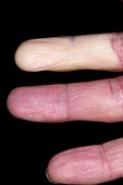 Raynauds phenomenon in finger