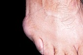 Bursitis of the fifth toe