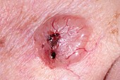 Basal cell skin cancer on cheek