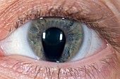 Coloboma of the eye